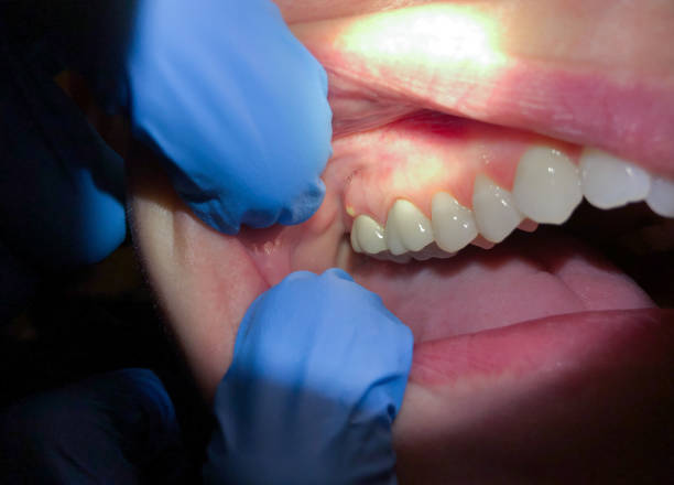 Best Emergency Treatment for Oral Infections in Petoskey, MI
